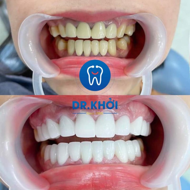 Răng sứ thẩm mỹ