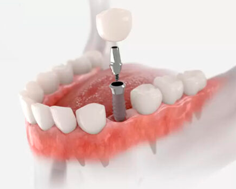 Implant Dentium