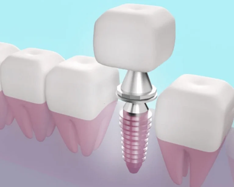 Implant Straumann