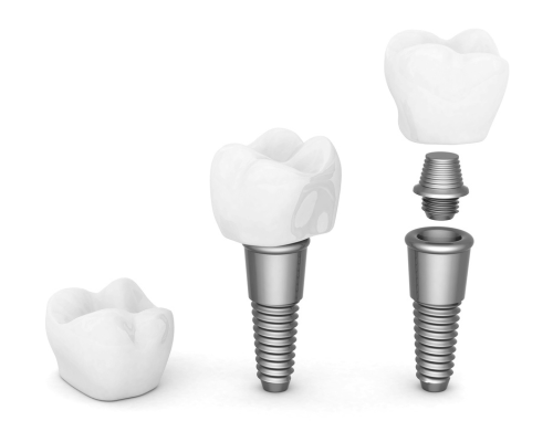 Implant BIOTEM