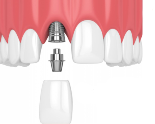 Implant Dentium
