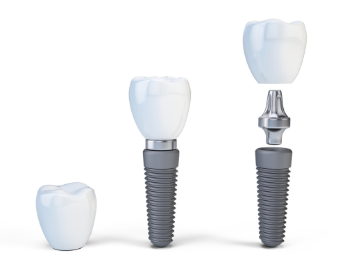 Implant Hiossen