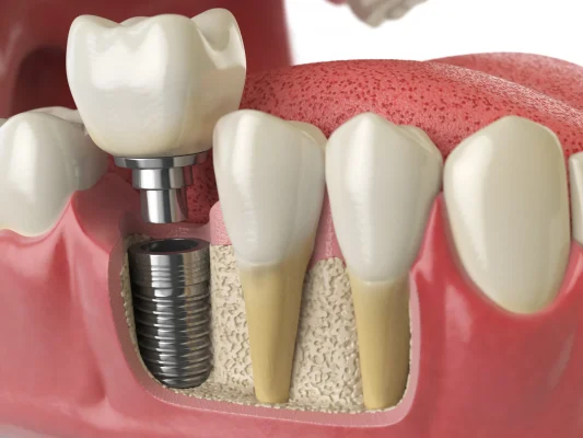 Implant IML