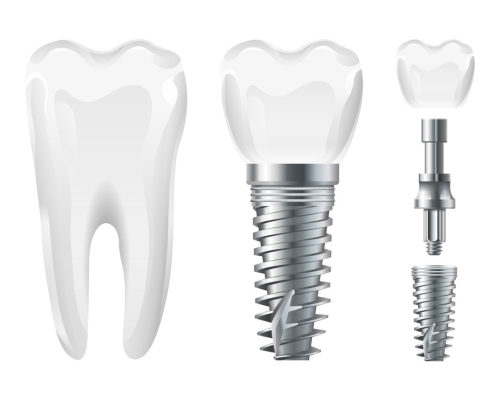 Implant Nobel Biocare