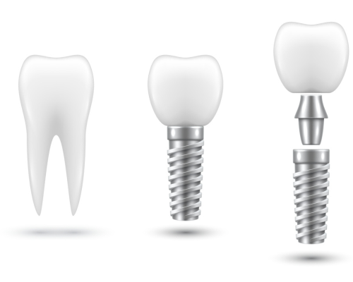Implant NOTCH C1 Alphabet