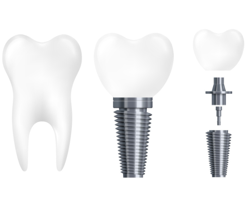 Implant Straumann