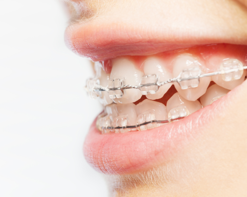 Niềng răng mắc cài sứ