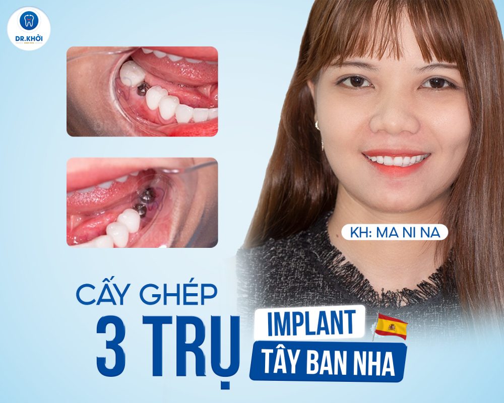 Khách hàng implant tại Nha Khoa Dr Khởi