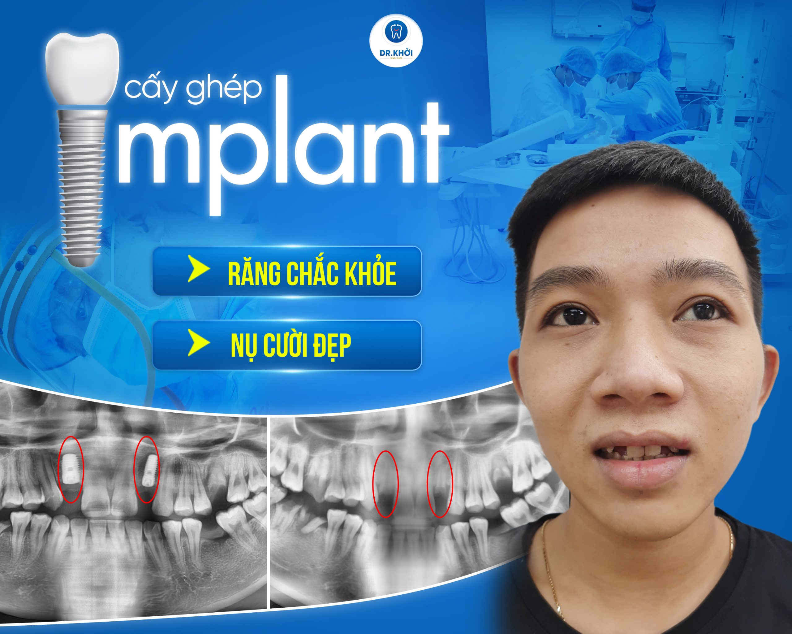 Khách hàng implant tại Nha Khoa Dr Khởi