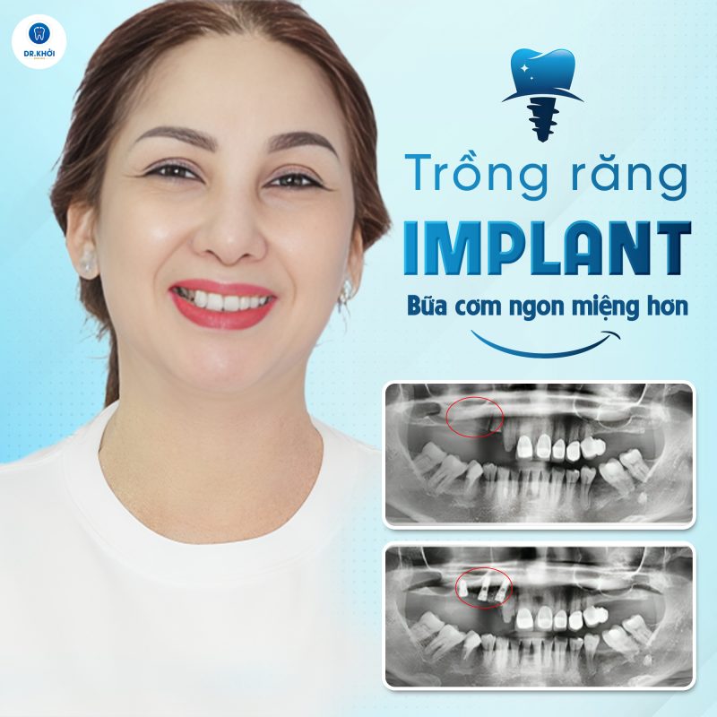 Khách hàng implant tại Nha Khoa Dr Khởi
