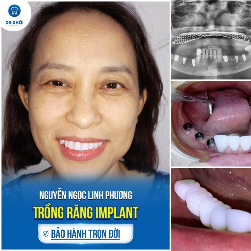 Khách hàng implant tại Nha Khoa Dr Khởi