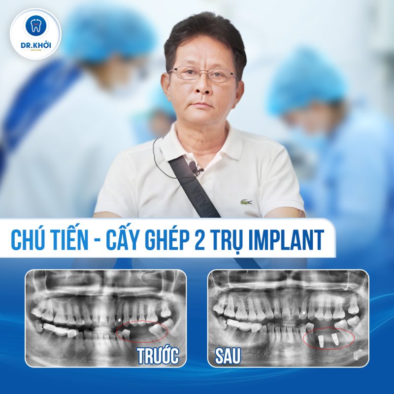 Khách hàng implant tại Nha Khoa Dr Khởi