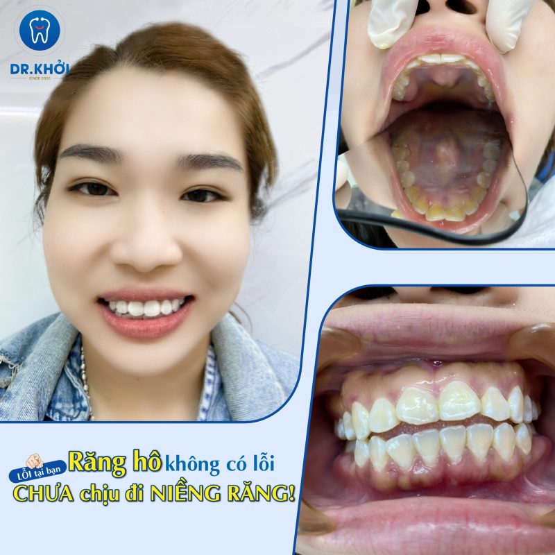 Khách hàng niềng răng tại Nha Khoa Dr Khởi