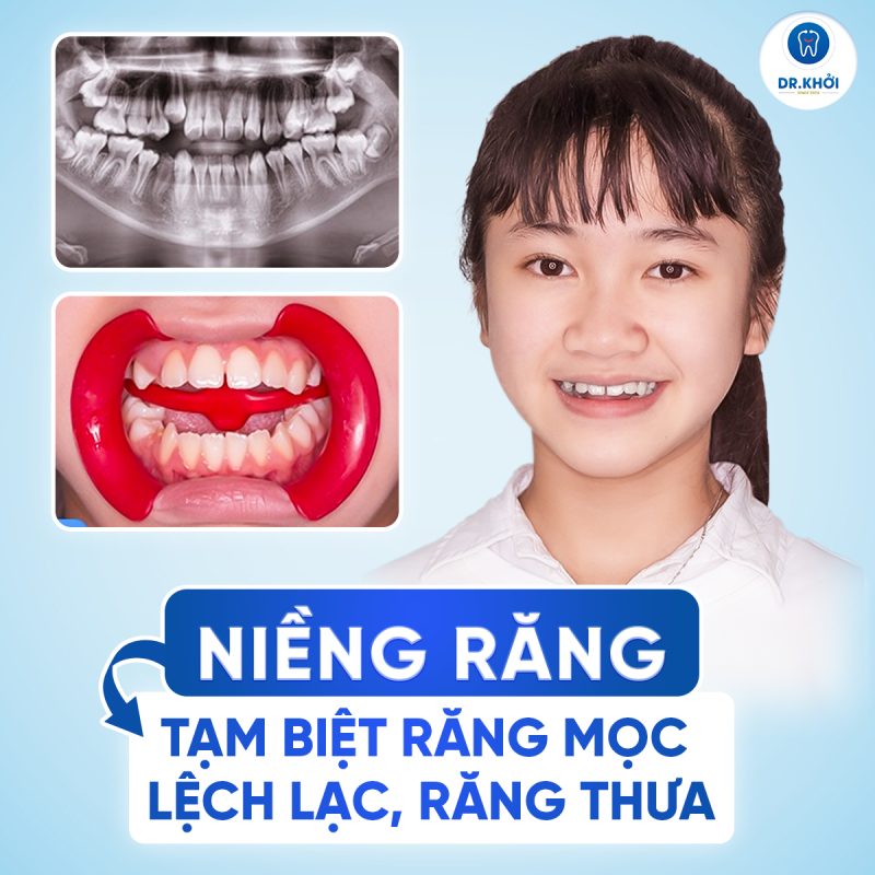 Khách hàng niềng răng tại Nha Khoa Dr Khởi