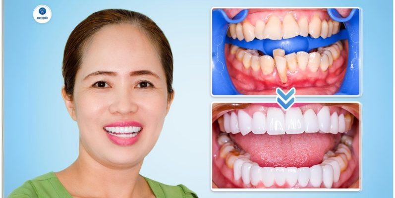 Khách hàng răng sứ tại Nha Khoa Dr Khởi