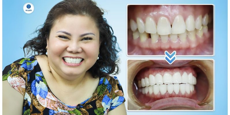 Khách hàng răng sứ tại Nha Khoa Dr Khởi