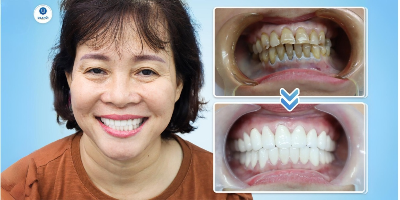 Khách hàng răng sứ tại Nha Khoa Dr Khởi