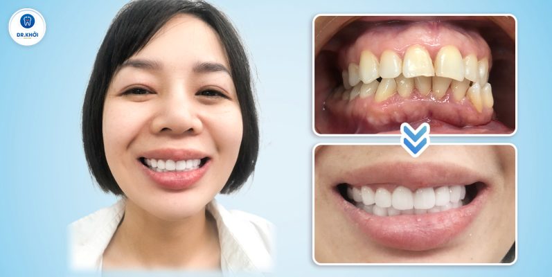 Khách hàng răng sứ tại Nha Khoa Dr Khởi