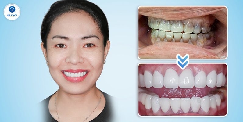 Khách hàng răng sứ tại Nha Khoa Dr Khởi