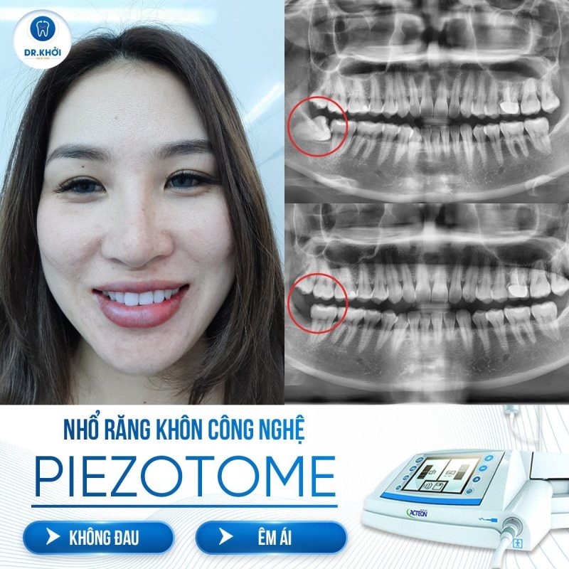 Khách hàng nha khoa tổng quát tại Nha Khoa Dr Khởi