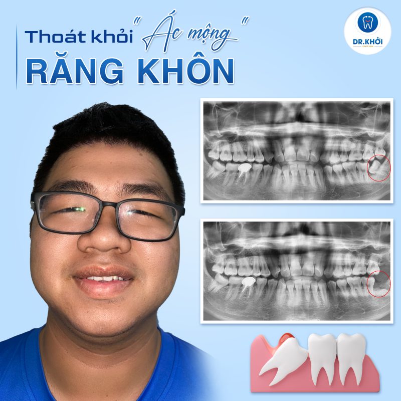 Khách hàng nha khoa tổng quát tại Nha Khoa Dr Khởi