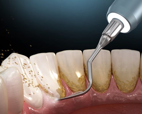 Vệ sinh, cạo vôi và đánh bóng răng