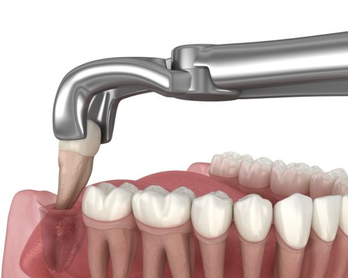 Nhổ tiểu phẫu răng khôn hàm dưới