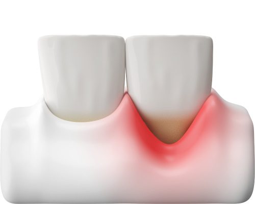 Điều trị viêm nha chu