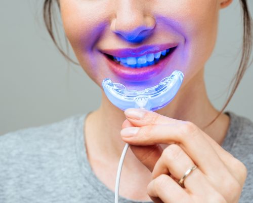 Tẩy trắng răng tại nhà