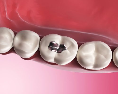 Trám răng thẩm mỹ