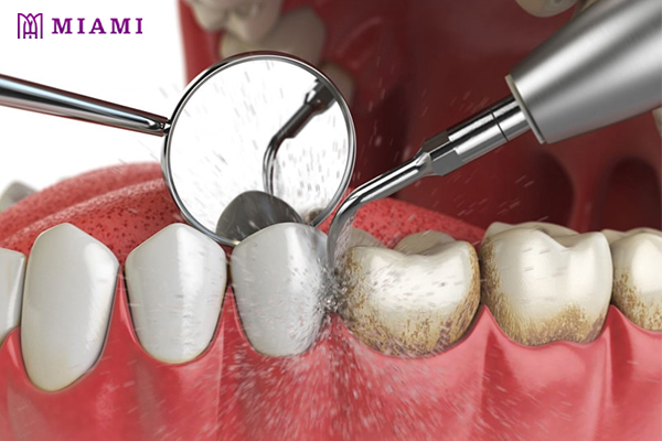 Lấy cao răng không gây đau nhức và không cần tiêm thuốc tê