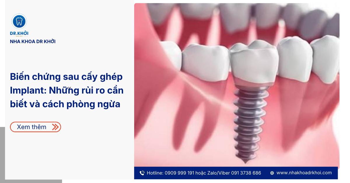 Biến chứng sau cấy ghép Implant: Những rủi ro cần biết và cách phòng ngừa