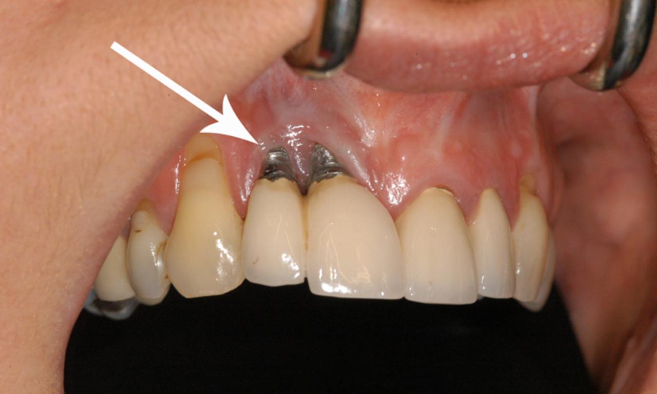 Răng Implant hoàn chỉnh gồm trụ titanium, khớp nối abutment và mão răng sứ