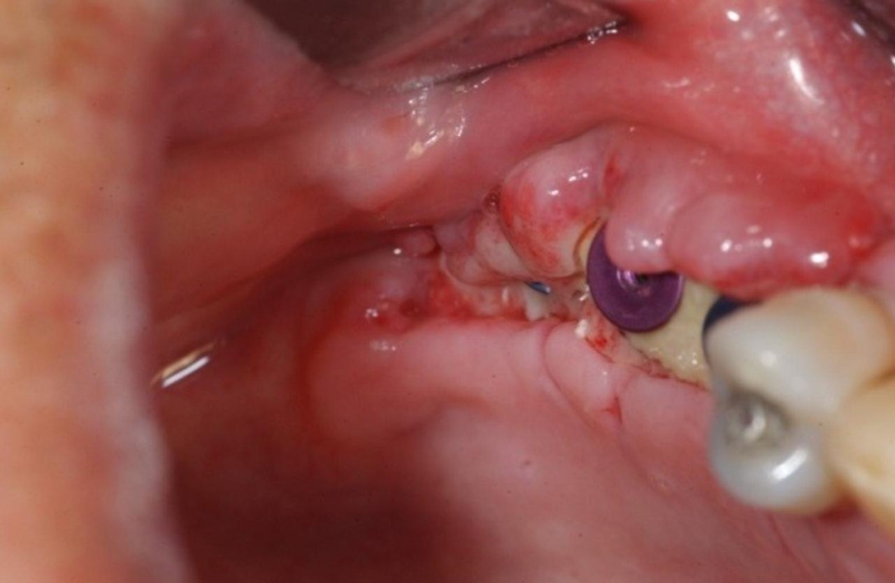 Hình ảnh minh họa các biến chứng có thể gặp sau cấy ghép Implant