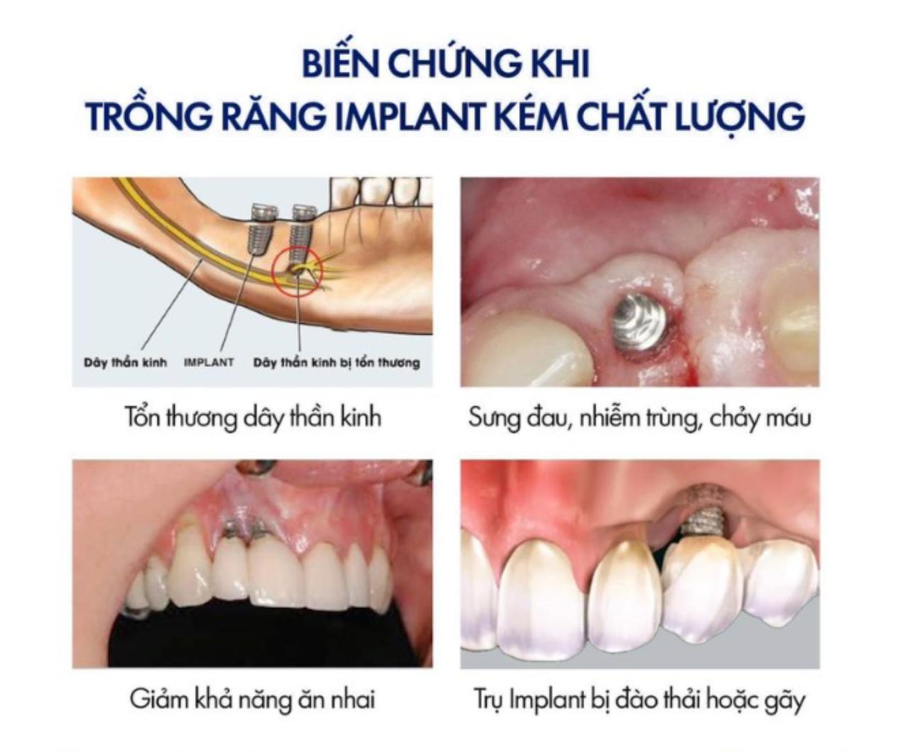 Biến chứng nhiễm trùng vùng cấy ghép Implant