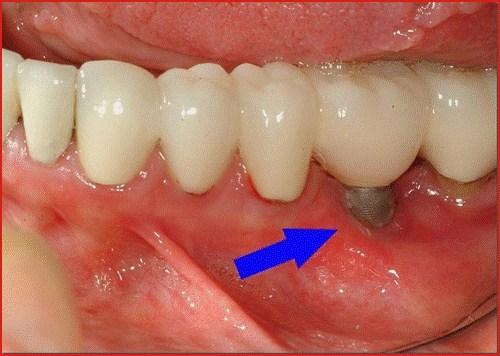 Chăm sóc răng miệng đúng cách sau cấy ghép Implant