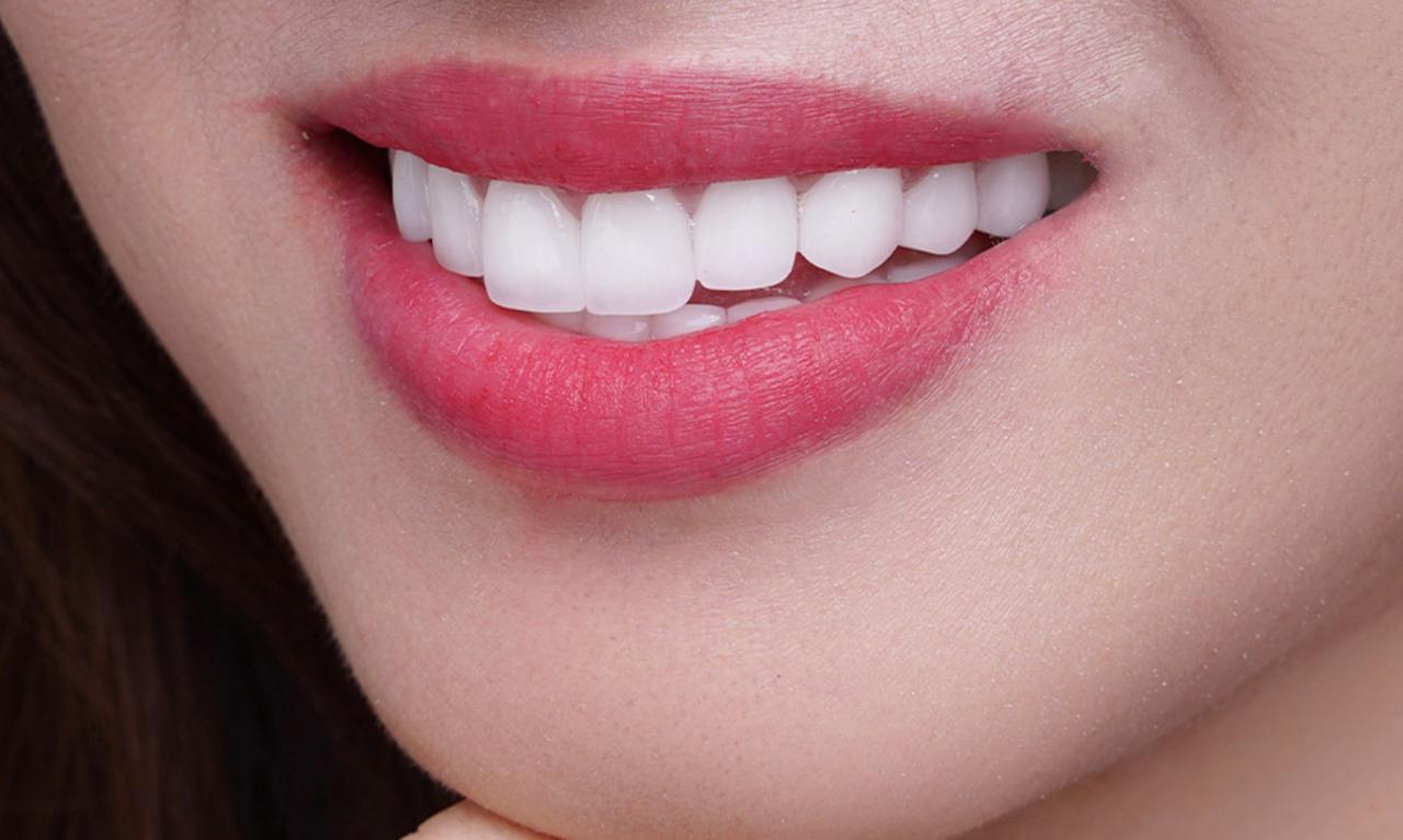 Răng sứ thỏ đẹp tự nhiên, cân xứng với các răng trên cung hàm