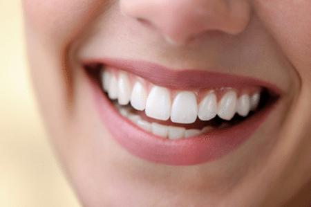 Dán sứ Veneer tạo dáng răng thỏ với mức mài răng tối thiểu